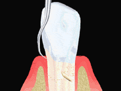 An animated depiction of a root planing procedure