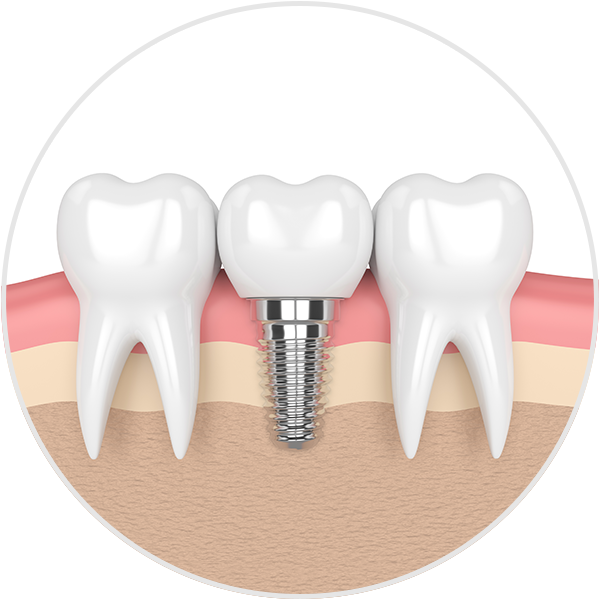 Illustration of Dental Implant between two teeth